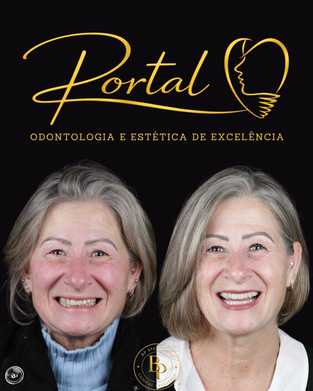 Paciente antes e depois da reabilitação do sorriso